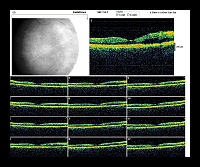 RADIAL LINE OD